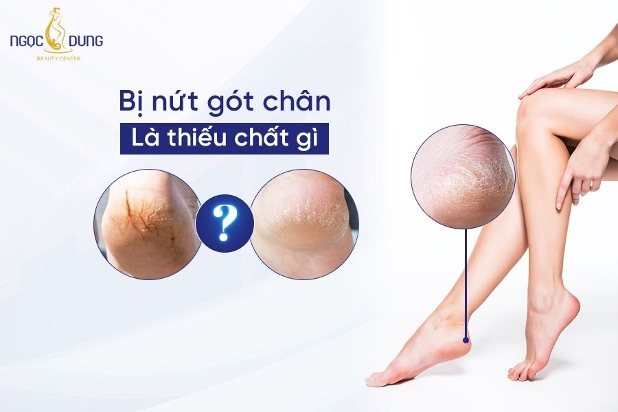 Bị nứt gót chân là thiếu chất gì? Hãy cùng chuyên gia tại Ngọc Dung Beauty tìm hiểu ngay