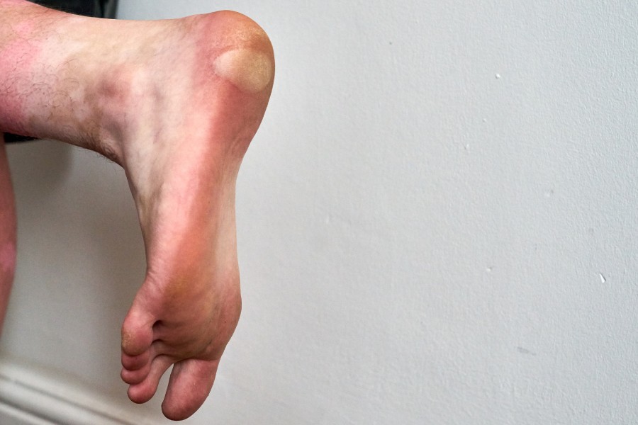 Rộp da lòng bàn chân là tình trạng hình thành các túi phồng chứa chất lỏng dưới da với nhiều kích thước khác nhau Gót chận bị phồng rộp