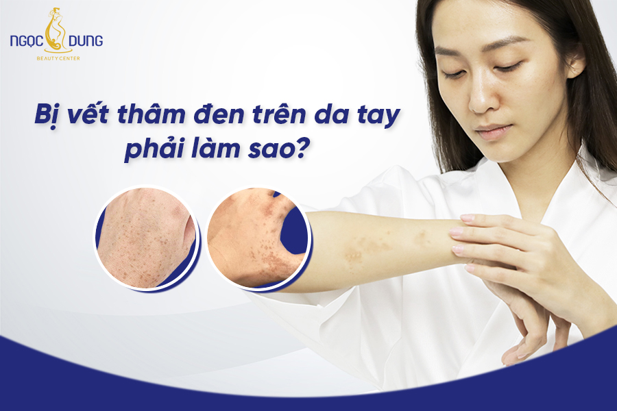 Nguyên nhân xuất hiện vết thâm đen trên da tay và cách trị hiệu quả. Theo dõi ngay!