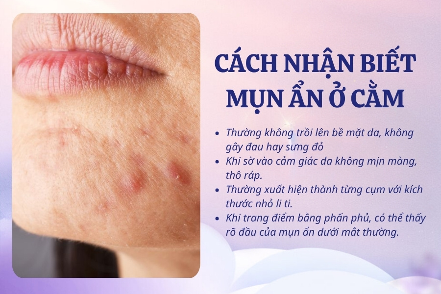 Mụn ẩn thường ẩn dưới bề mặt da, không gây đau hay sưng đỏ Mụn ẩn thường ẩn dưới bề mặt da, không gây đau hay sưng đỏ
