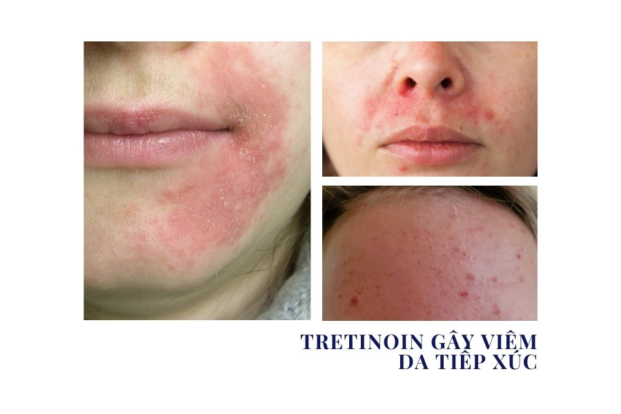 Dùng Tretinoin với Vitamin C cùng lúc gây viêm da