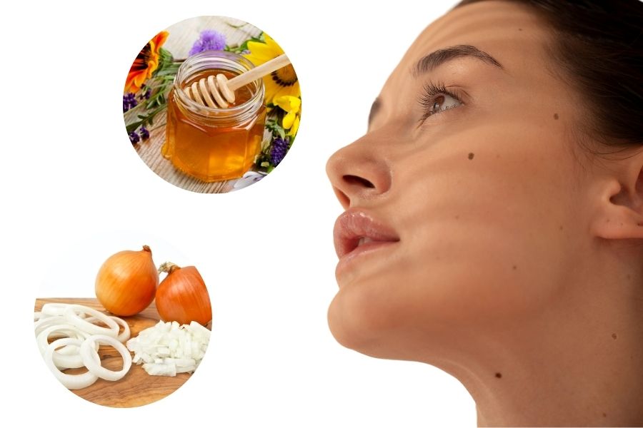Dùng hành tây và mật ong để tẩy nốt ruồi to và lồi ngay tại nhà