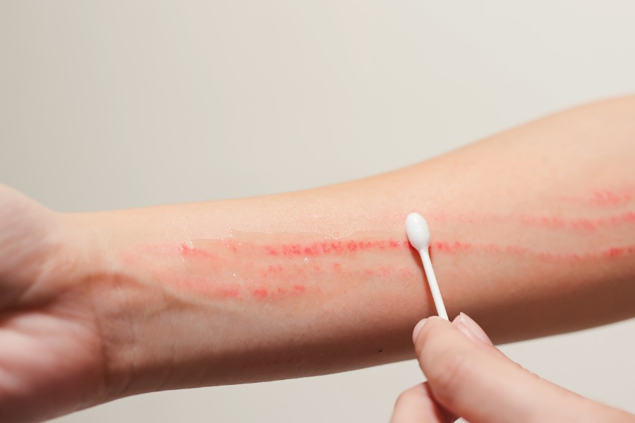 Thoa thuốc mỡ đều đặn để làm dịu vết thương và thúc đẩy quá trình phục hồi hiệu quả hơn Thoa thuốc mỡ đều đặn để làm dịu vết thương và thúc đẩy quá trình phục hồi hiệu quả hơn