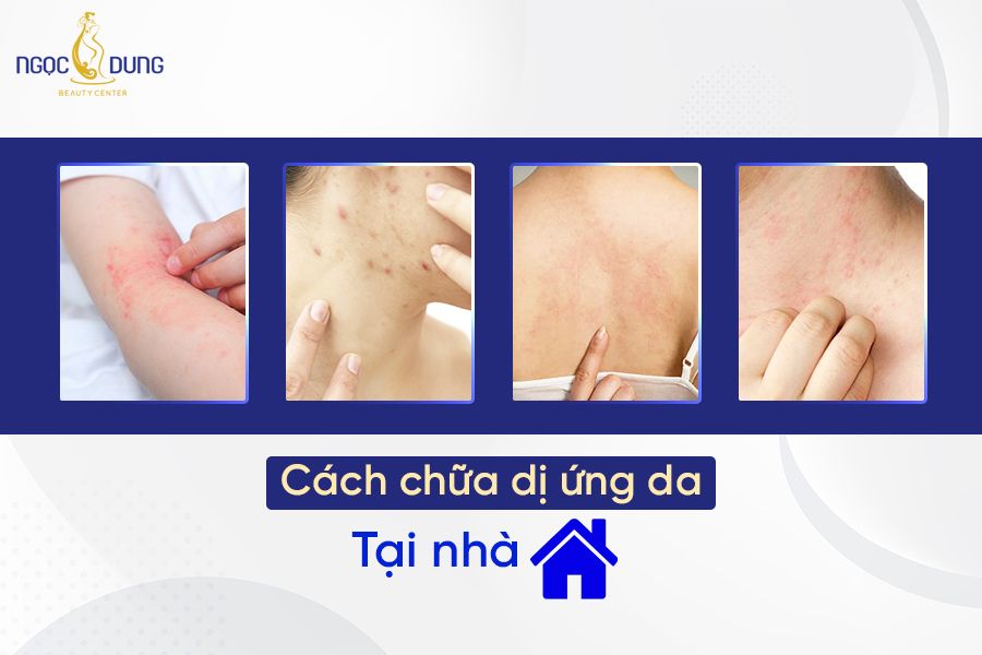 cách chữa dị ứng da tại nhà