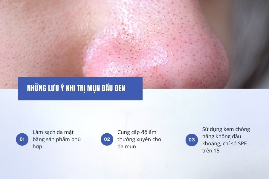 Những điều cần lưu ý khi áp dụng cách trị mụn đầu đen ở mũi tại nhà