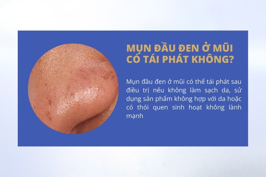Mụn đầu đen ở mũi có tái phát không?