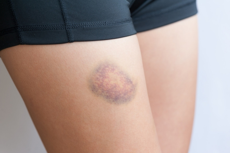 Vết bầm tím có thể xảy ra do nhiều nguyên nhân khác nhau có cả nội sinh lẫn tác nhân bên ngoài