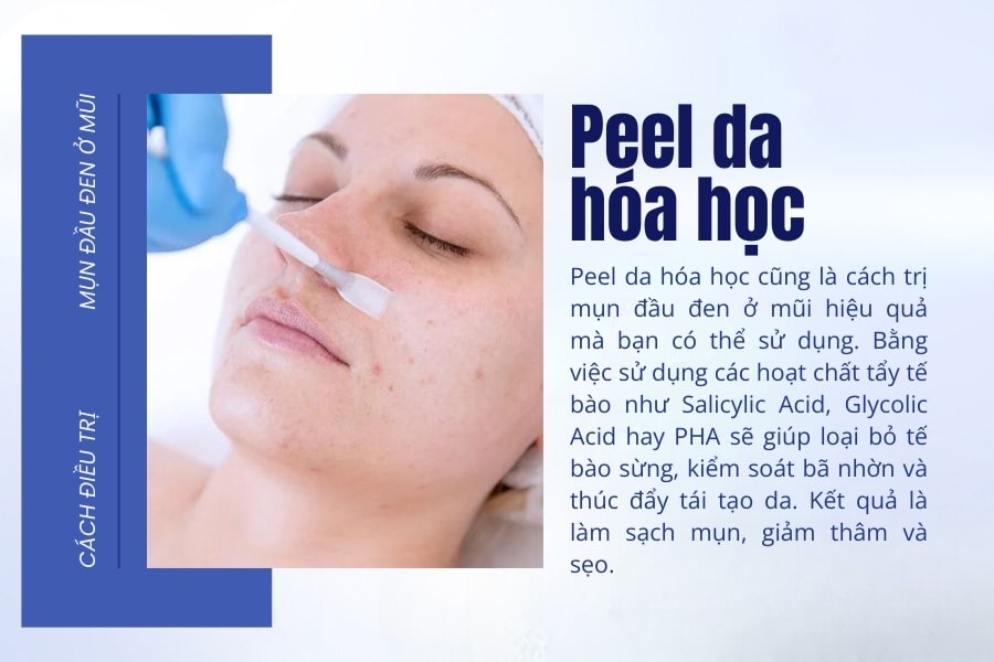 Peel da vùng mũi - Cách làm hết mụn đầu đen ở mũi nhanh nhất