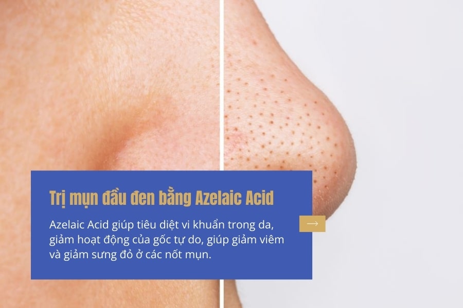 Mẹo hết mụn đầu đen ở mũi bằng Axit Azelaic 