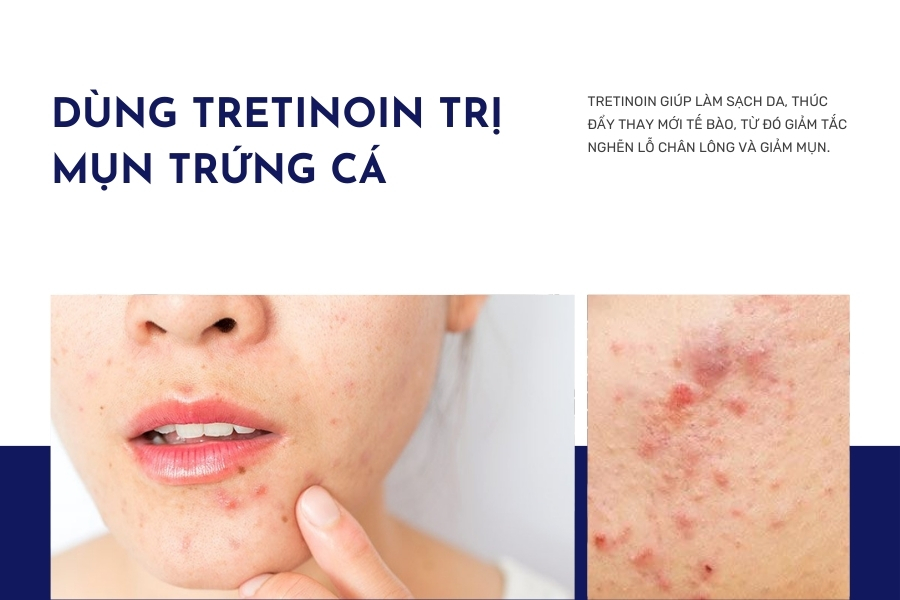 Công dụng Tretinoin đối với da bị mụn trứng cá