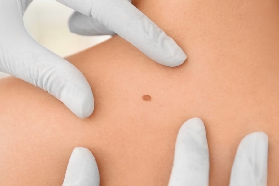 Nốt ruồi có thể xuất hiện với kích thước và màu sắc khác nhau, thường là màu đen hoặc nâu