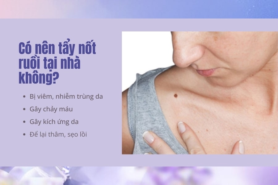 Có nên tẩy nốt ruồi tại nhà không?