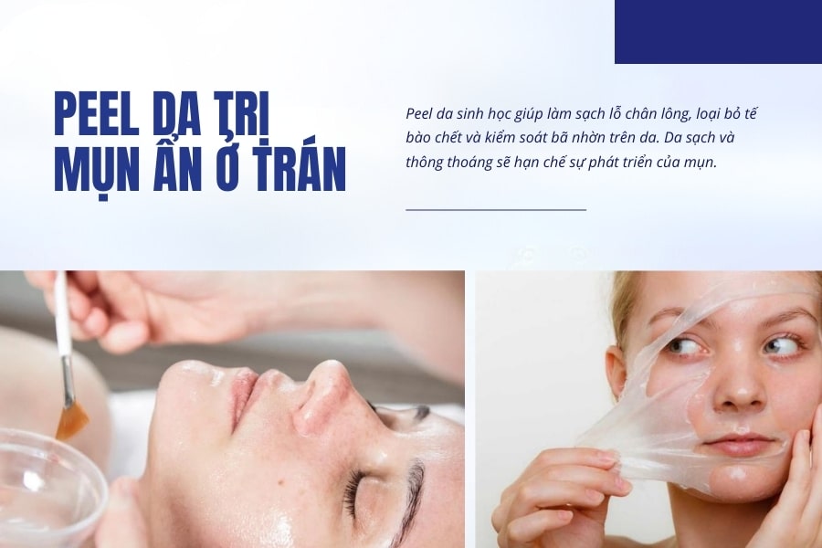 Cách chữa mụn ẩn trên trán bằng peel da sinh học Cách chữa mụn ẩn trên trán bằng peel da sinh học