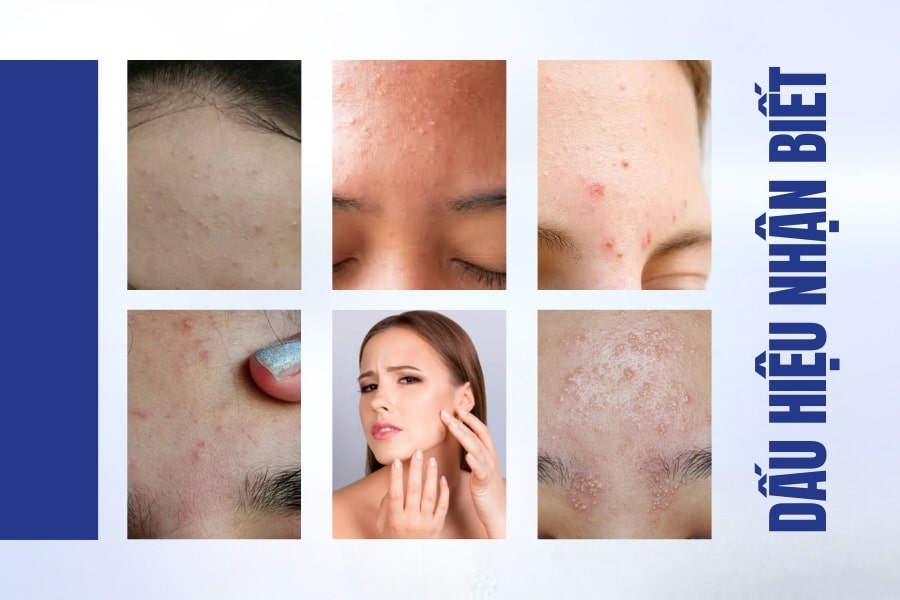 Cách nhận biết mụn ẩn dưới da ở trán Cách nhận biết mụn ẩn dưới da ở trán