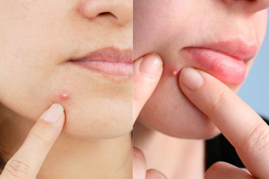 Một số dấu hiệu nhận biết mụn đầu trắng Một số dấu hiệu nhận biết mụn đầu trắng