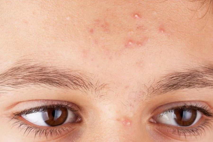 Lỗ chân lông bị bít tắc là nguyên nhân chính dẫn đến sự hình thành của mụn đầu trắng Lỗ chân lông bị bít tắc là nguyên nhân chính dẫn đến sự hình thành của mụn đầu trắng