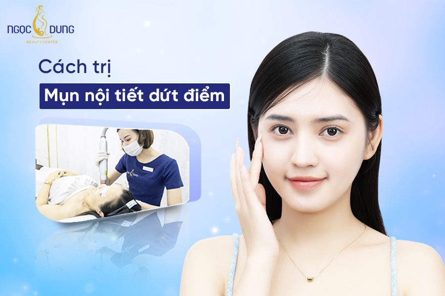 Bật mí cách trị mụn nội tiết dứt điểm an toàn hiệu quả chị em nên lưu lại