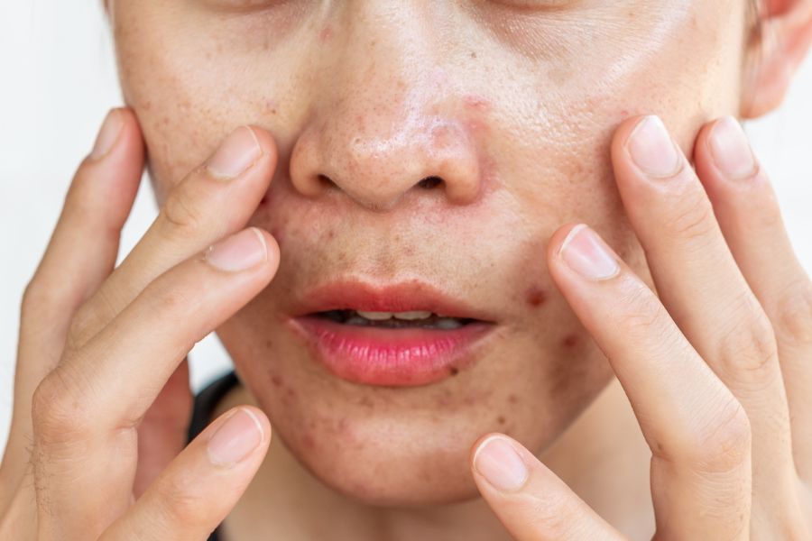 Mụn nội tiết có thể chữa được nếu thực hiện đúng phương pháp và không bỏ cuộc giữa chừng