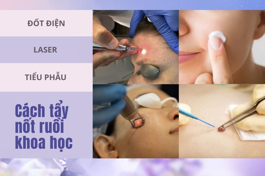 Phương án y khoa thay thế các cách trị nốt ruồi tại nhà