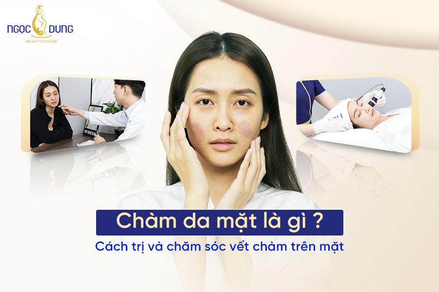 chàm da mặt