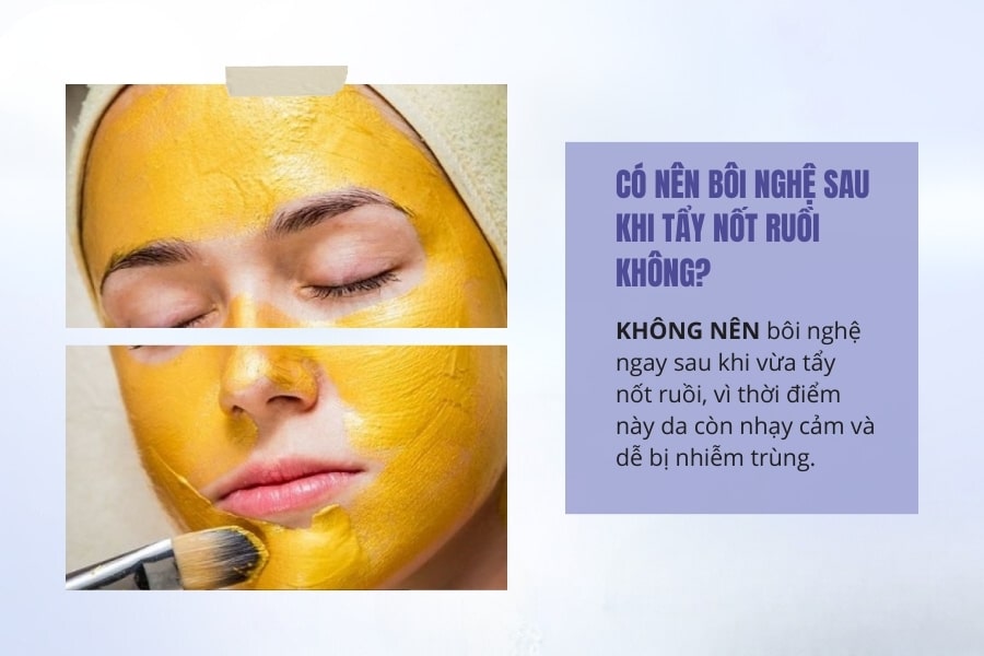 Có nên bôi nghệ sau khi tẩy nốt ruồi không? Tẩy nốt ruồi bao lâu thì bôi nghệ?