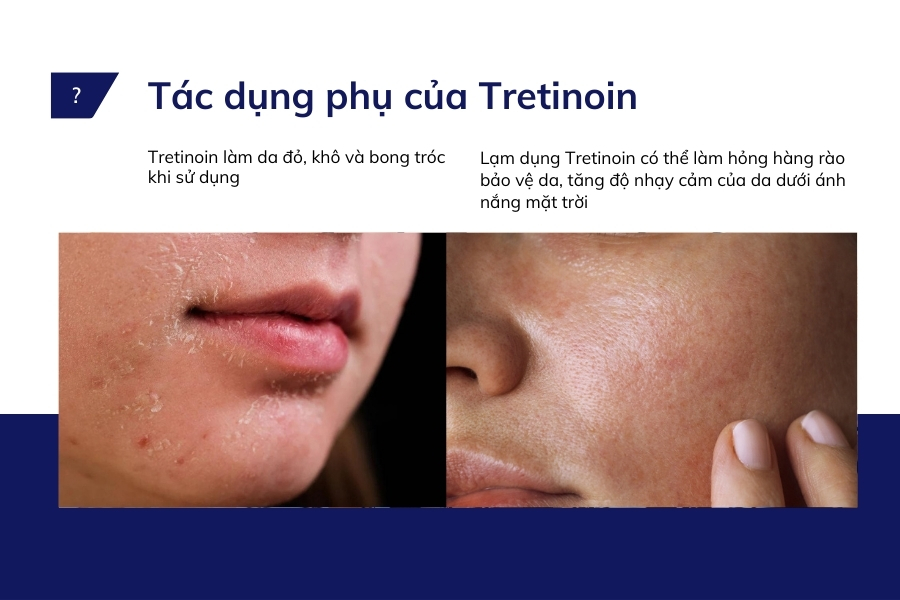 Tác dụng phụ cần lưu ý khi dùng thuốc Tretinoin trị nám