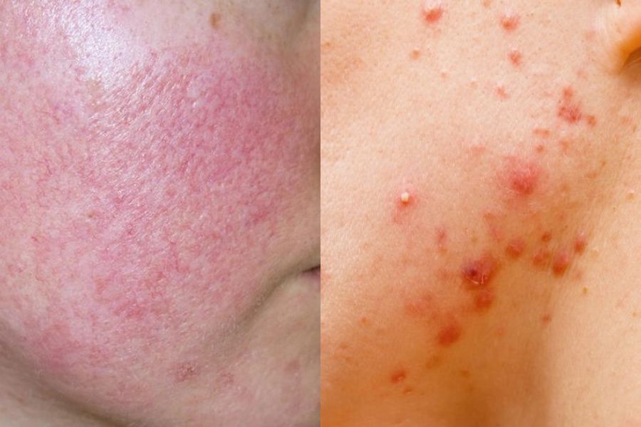Các dấu hiệu cho thấy da đang bị nhiễm corticoid
