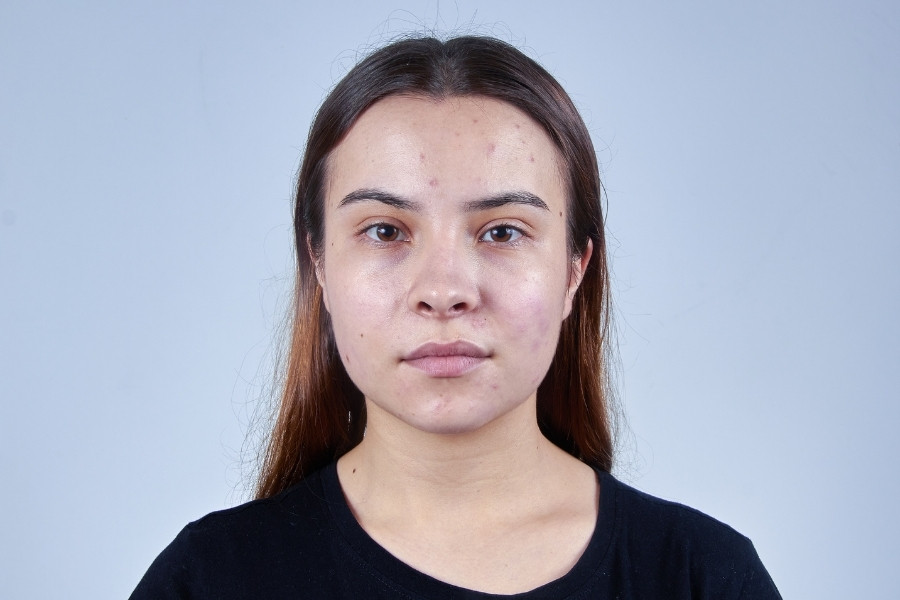 Da dầu thường luôn trong tình trạng bóng dầu và dễ xuất hiện viêm mụn