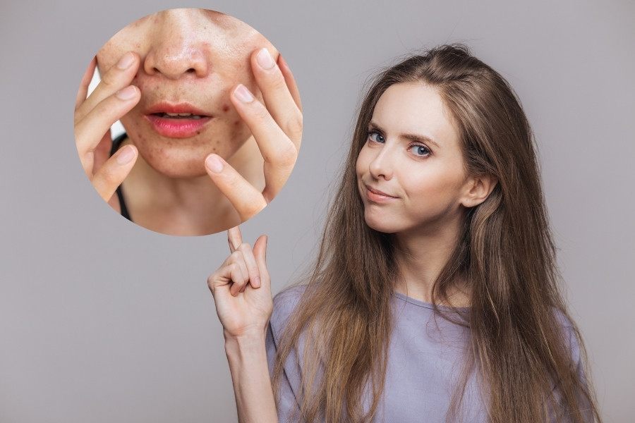 Da dầu nên dưỡng ẩm không