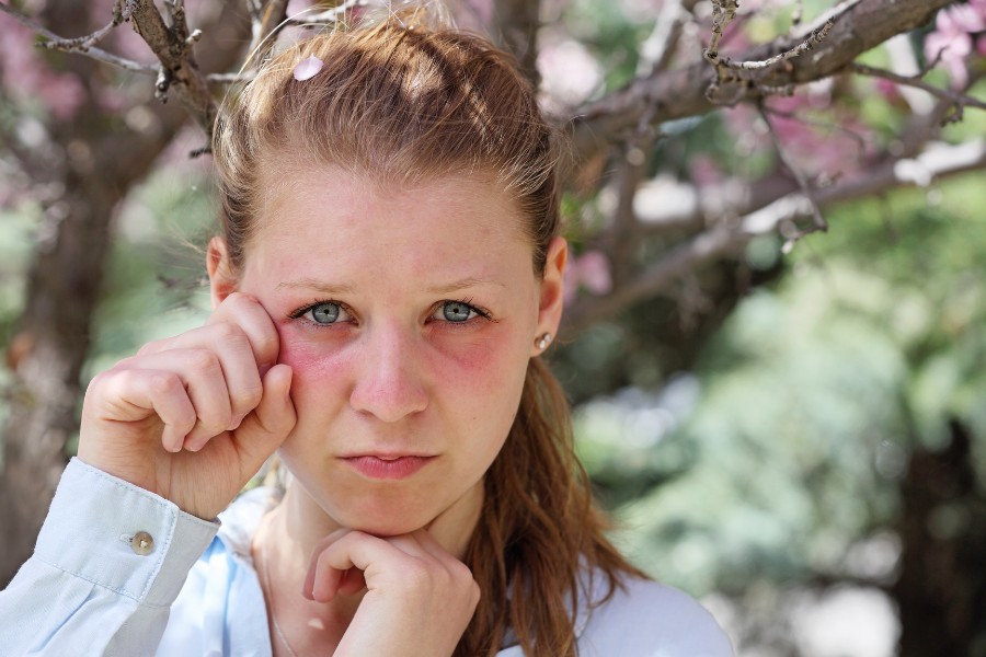 Da mặt bị dị ứng thời tiết có thể xuất hiện triệu chứng sưng rộp ở vùng mắt, má và môi