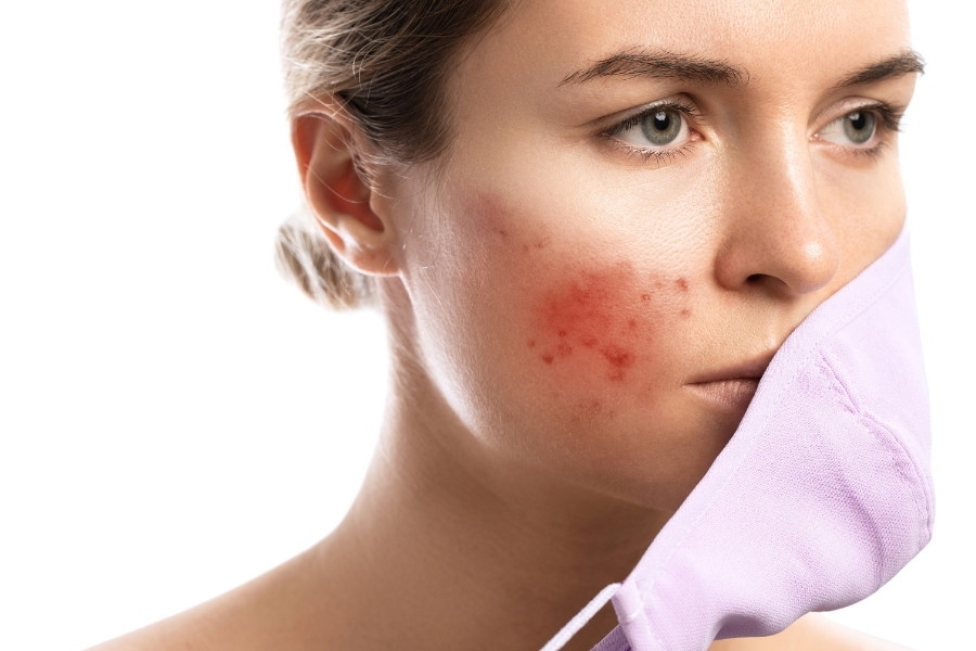 Da mặt ứng đỏ, viêm mụn do tác nhân gây hại từ môi trường da mặt bị đỏ do cơ địa