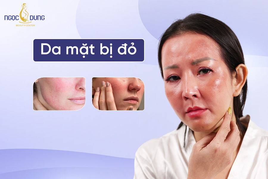 da mặt bị đỏ