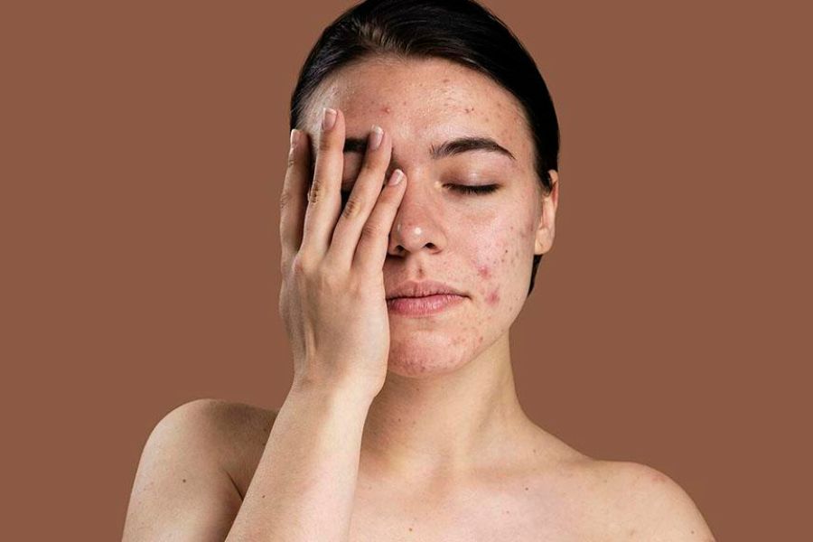 Da nhiễm Corticoid là tình trạng suy giảm hàng rào bảo vệ của da, giãn mạch máu 