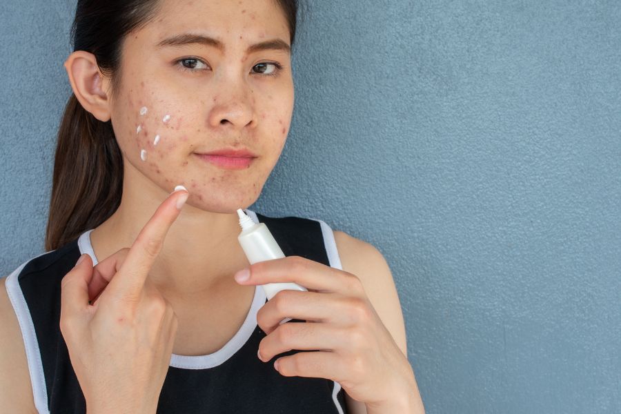 Đối với mụn nhẹ bạn có thể sử dụng các loại kem trị mụn để diệt khuẩn, làm giảm tiết dầu