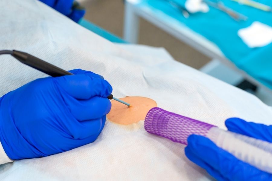 Loại bỏ nốt ruồi nhanh chóng bằng phương pháp đốt điện