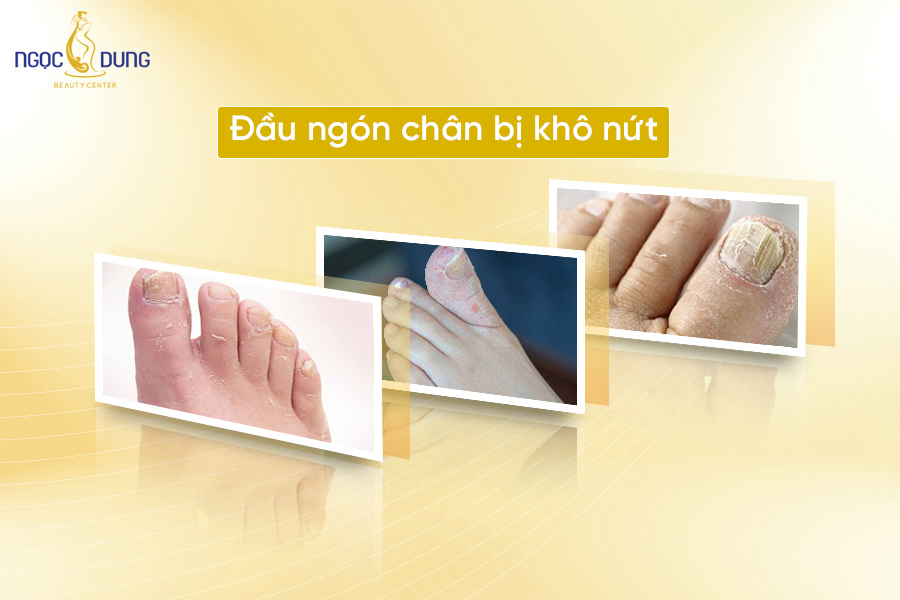 dau ngon chan bi kho nut