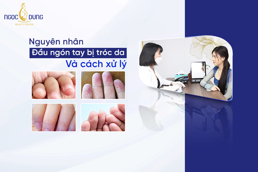 Nguyên nhân đầu ngón tay bị tróc da và cách xử lý