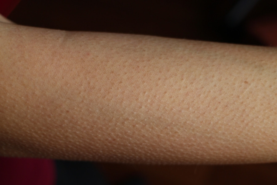 Tình trạng nổi gai ốc là một vấn đề liễu khoa khá phổ biến, không ảnh hưởng đến sức khỏe