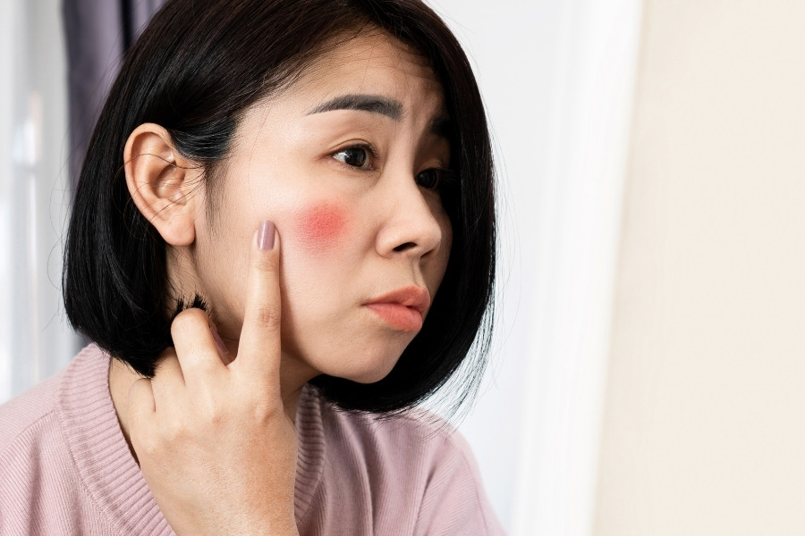 Da mặt bị đỏ do sự xuất hiện quá nhiều của các loại ký sinh trùng Da mặt bị đỏ do sự xuất hiện quá nhiều của các loại ký sinh trùng