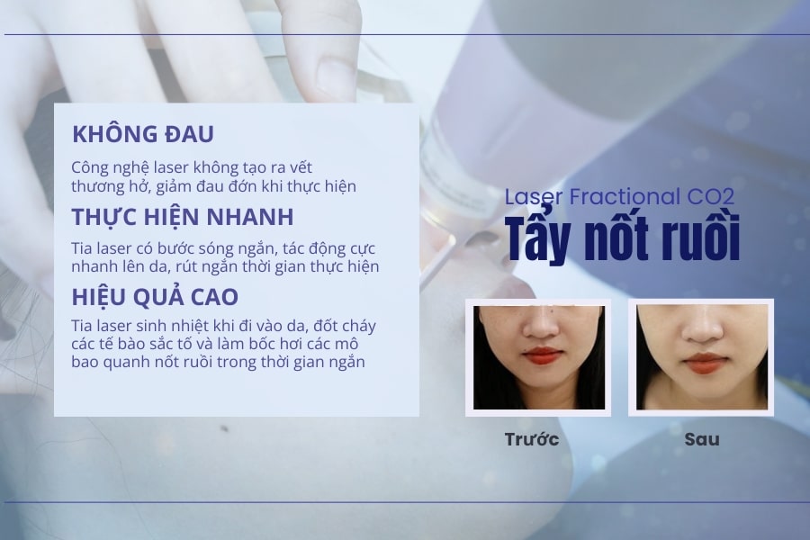Nên tẩy, xóa nốt ruồi ở đâu uy tín và an toàn?