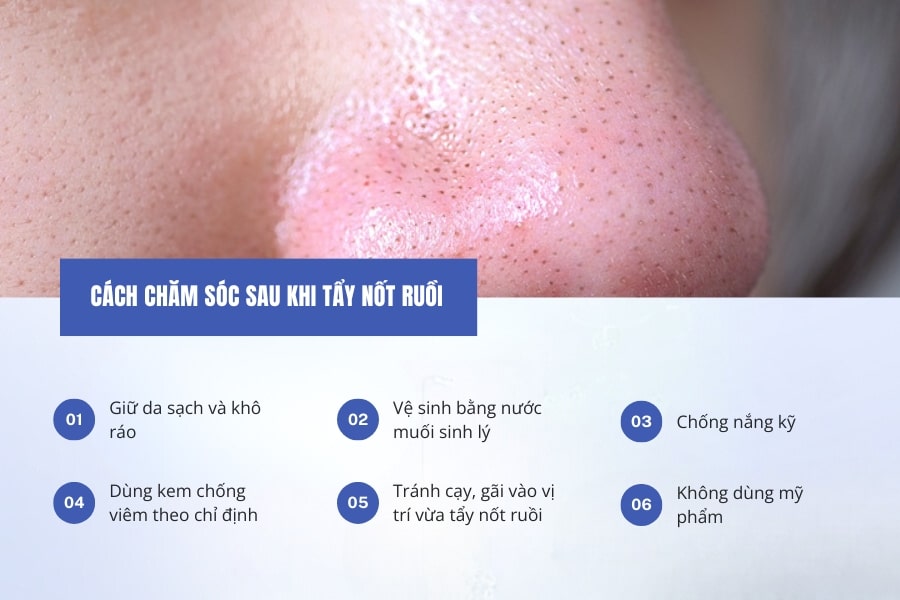 Cách chăm sóc da sau khi tẩy nốt ruồi để không để lại sẹo xấu
