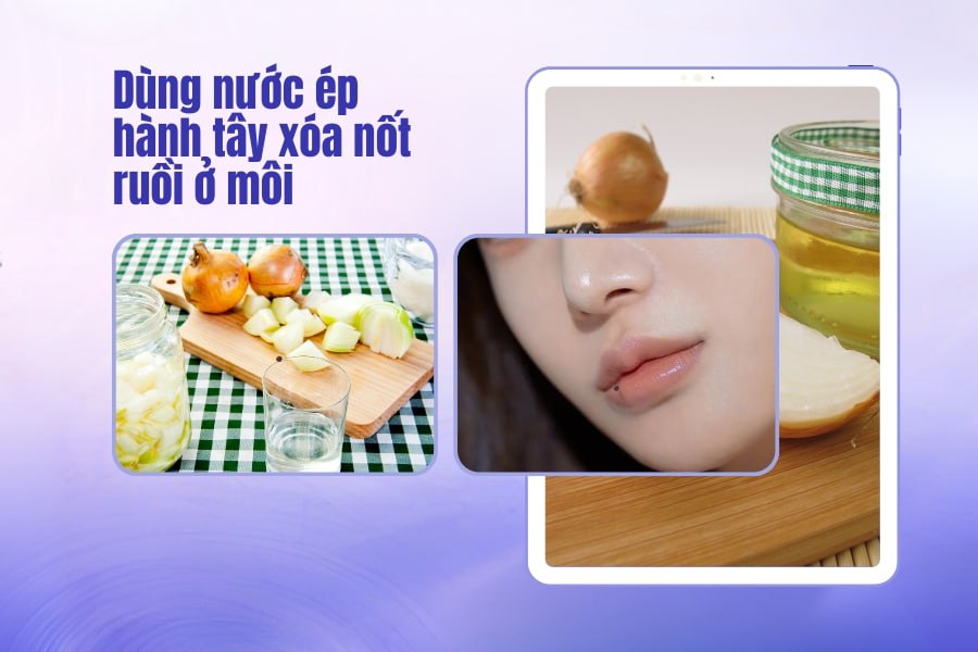 Dùng nước ép hành tây xóa nốt ruồi trên môi Dùng nước ép hành tây xóa nốt ruồi trên môi