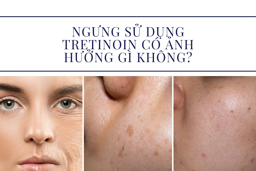 Ngưng sử dụng tretinoin có ảnh hưởng gì không?