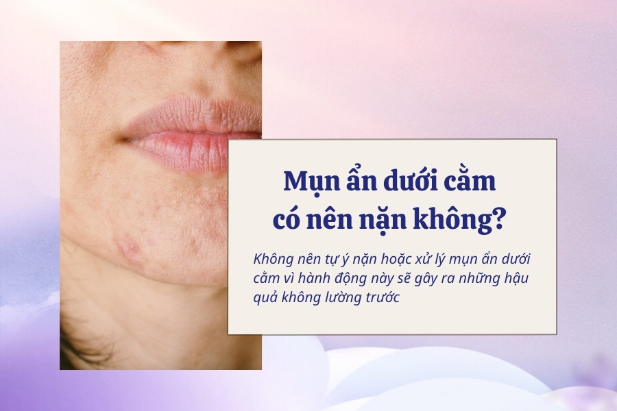 Không nên nặn mụn tại nhà, bởi nặn mụn không đúng cách có thể gây sưng viêm Không nên nặn mụn tại nhà, bởi nặn mụn không đúng cách có thể gây sưng viêm