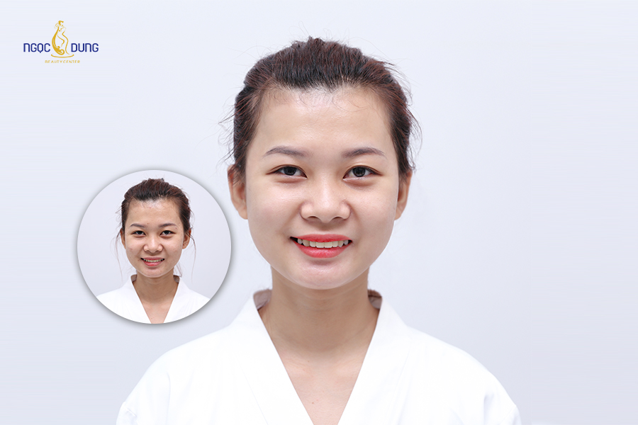 Lấy lại sức sống và thần thái tự tin sau khi “tạm biệt” sẹo rỗ chỉ với 1 liệu trình điều trị