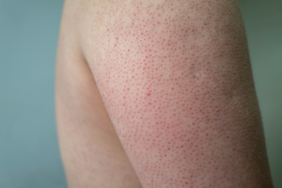 Dày sừng nang lông là một tình trạng da khá phổ biến và lành tính