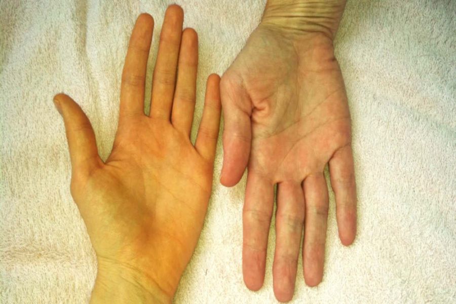 Da vàng thiếu chất gì? Làm sao để cải thiện và ngăn ngừa 2 Da vàng thiếu chất gì? Theo chuyên gia tình trạng thiếu sắt có thể khiến da chuyển sang màu vàng