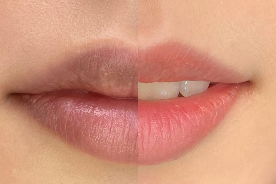 laser trị thâm môi tại tmv ngọc dung nhanh chóng an toàn laser trị thâm môi tại tmv ngọc dung nhanh chóng an toàn