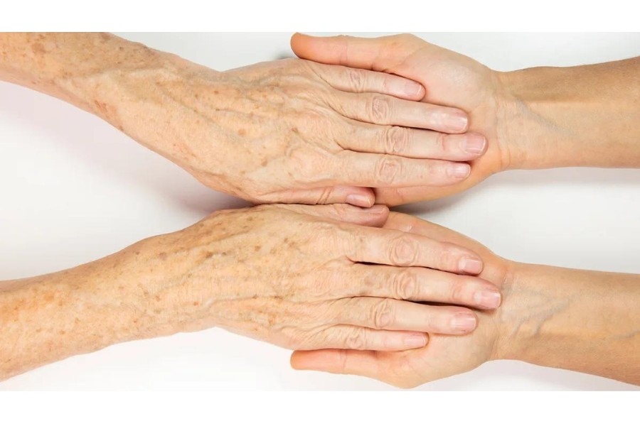 Sự xuất hiện vết thâm đen trên da có thể do quá trình lão hóa da Sự xuất hiện vết thâm đen trên da có thể do quá trình lão hóa da