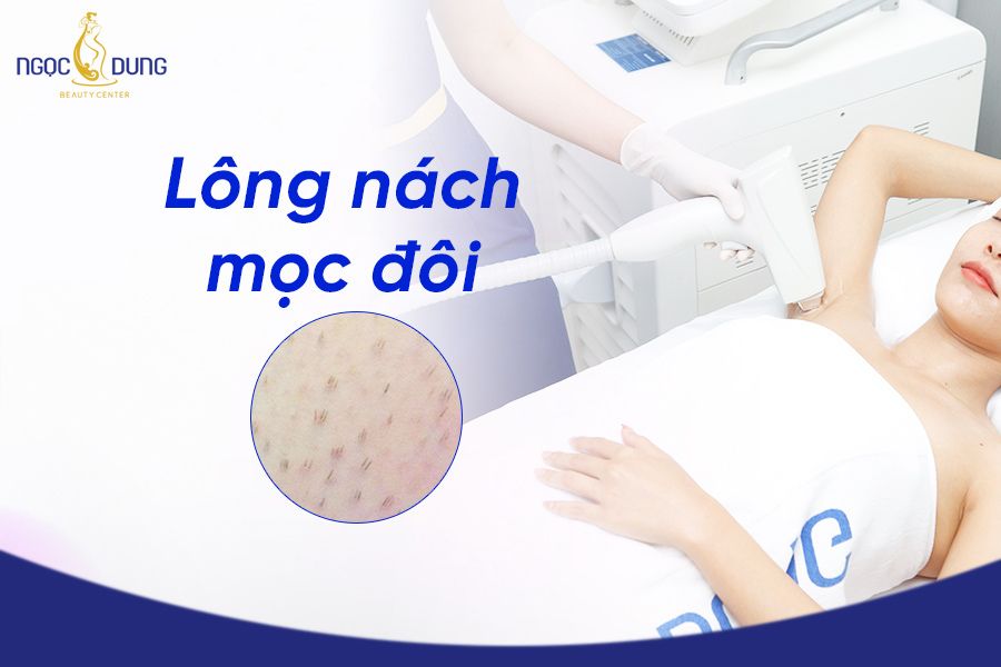Lông nách mọc đôi là gì? Cách điều trị như thế nào mới hiệu quả? Tìm hiểu ngay